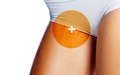 Comment prévenir les poils incarnés