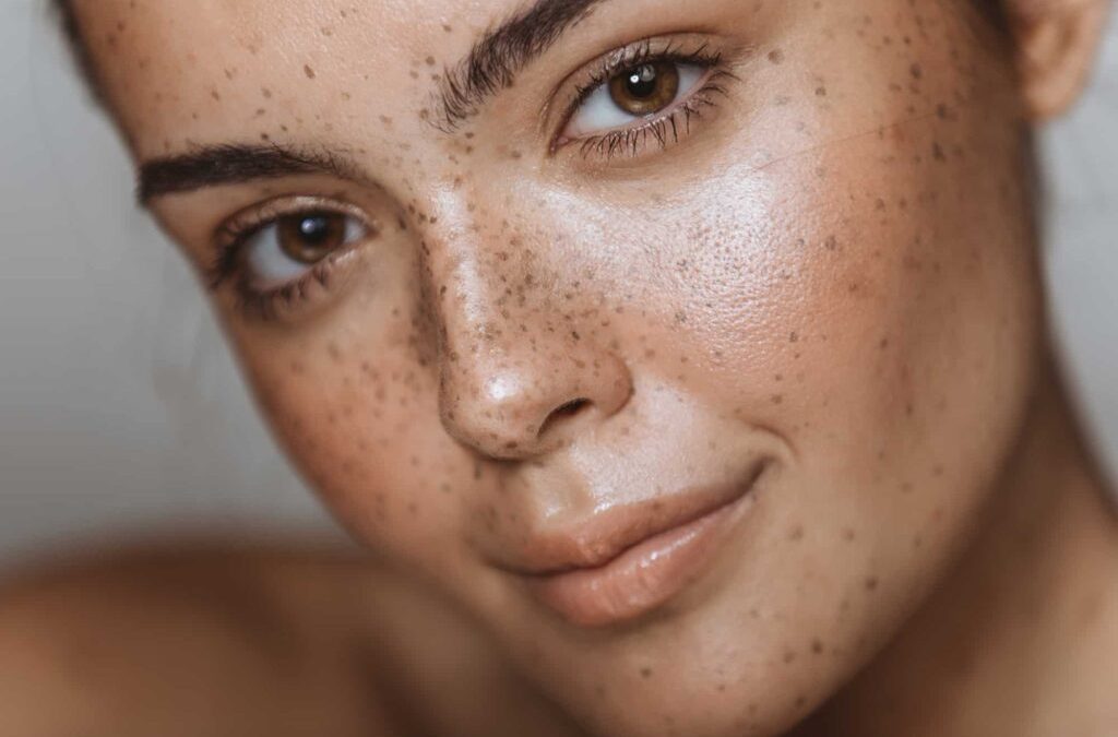 Comment se débarrasser de l’hyperpigmentation du visage ?