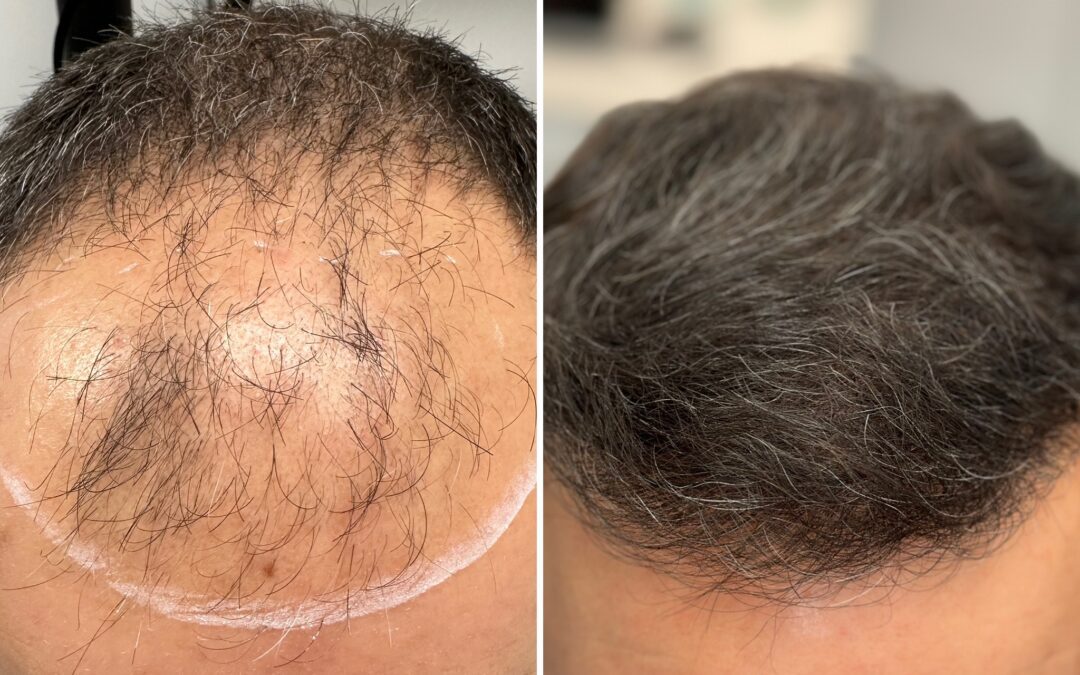 Greffe de Cheveux FUE à Lyon