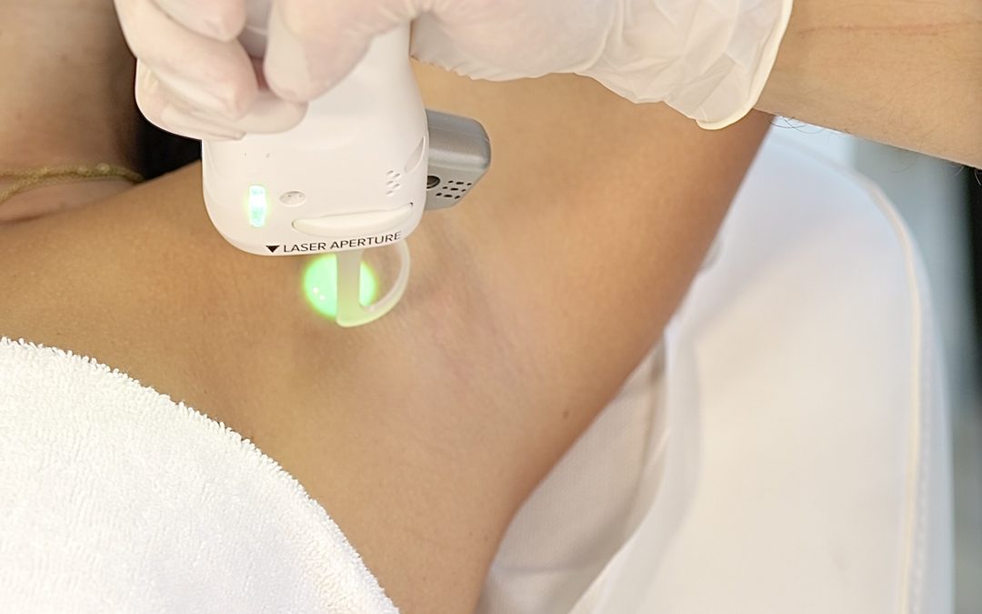 L’épilation au laser, la solution pour les poils incarnés