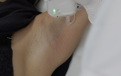 Épilation laser et mode de vie active