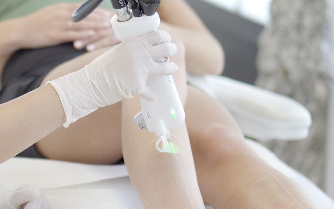 Épilation au laser et peau sensible : est-ce possible ?