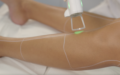 L’épilation au laser et le vitiligo