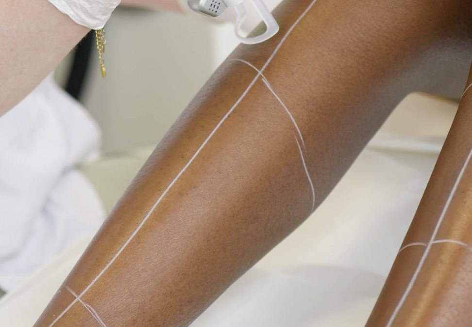 L’épilation laser, mythes et réalités !