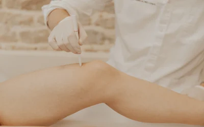 Épilation laser et SOPK