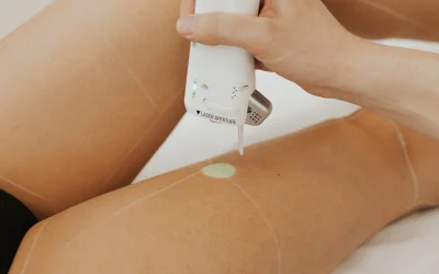 Épilation laser et grains de beauté