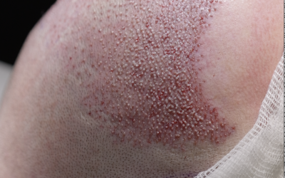 Greffe capillaire : Risques et complications