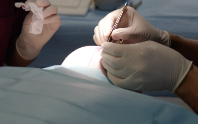 Stimuler la pousse après une greffe : faut-il des médicaments