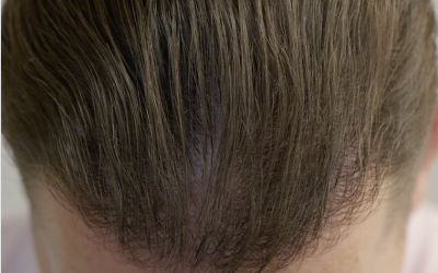 L’impact psychologique de la greffe capillaire