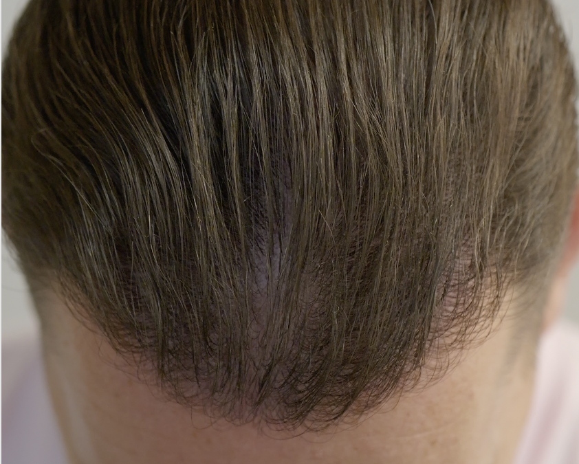 L’impact psychologique de la greffe capillaire