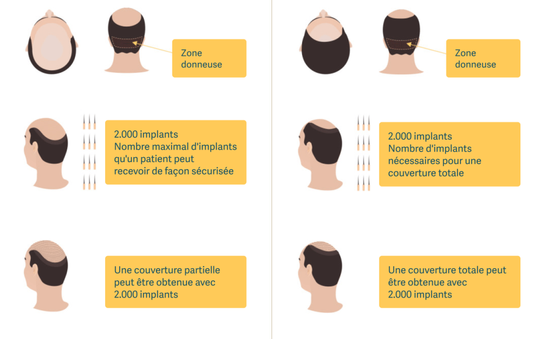 La zone donneuse pour une greffe capillaire