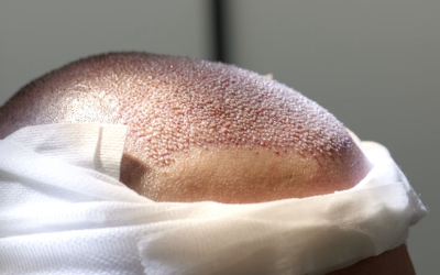 La greffe capillaire nécessite-t-elle une hospitalisation ?