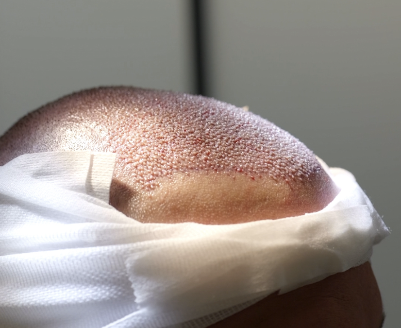 La greffe capillaire nécessite-t-elle une hospitalisation ?