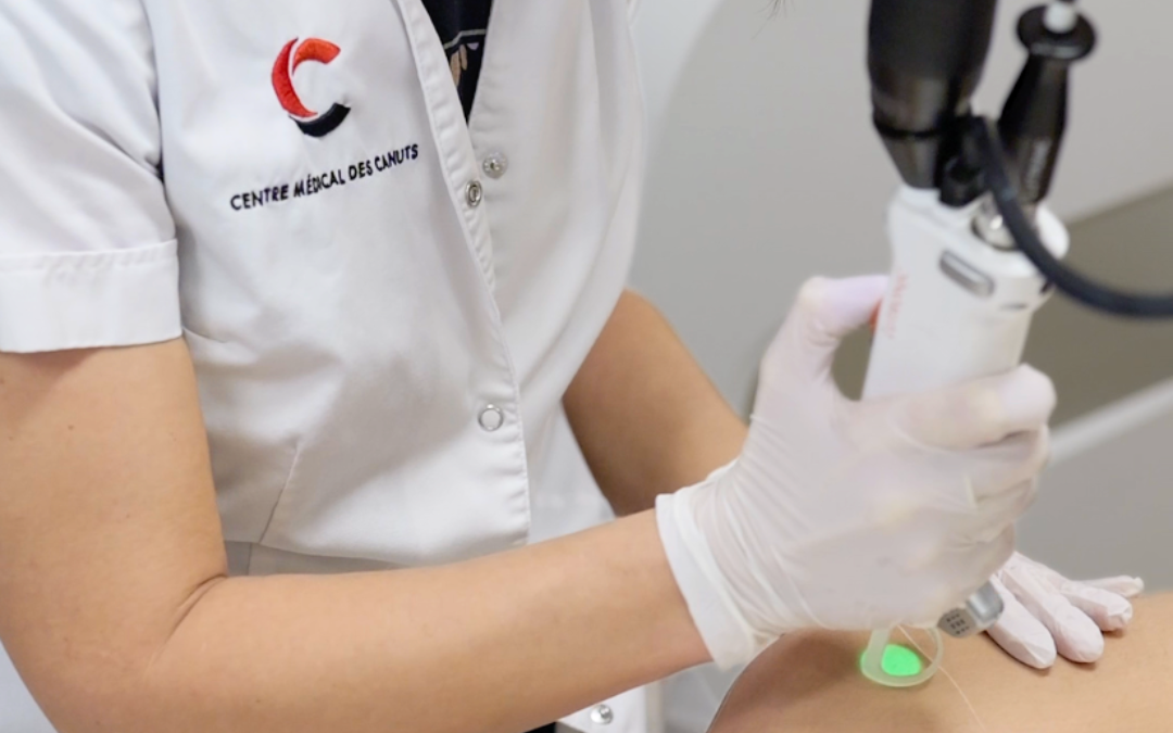 Épilation laser et contraception