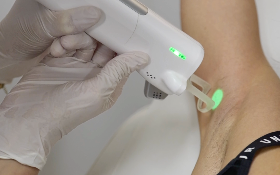 L’épilation laser, une alternative plus durable et moins polluante