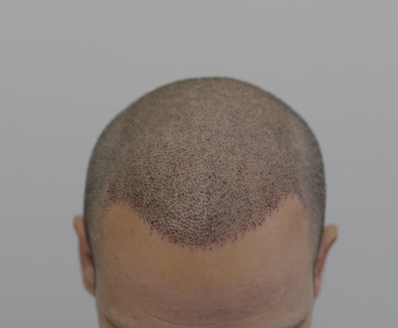 La consultation pré-opératoire d’une greffe capillaire