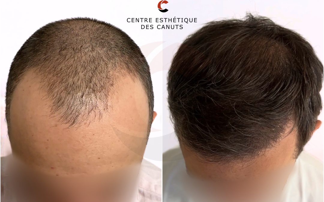 Comment éviter les fausses promesses de la greffe capillaire ?