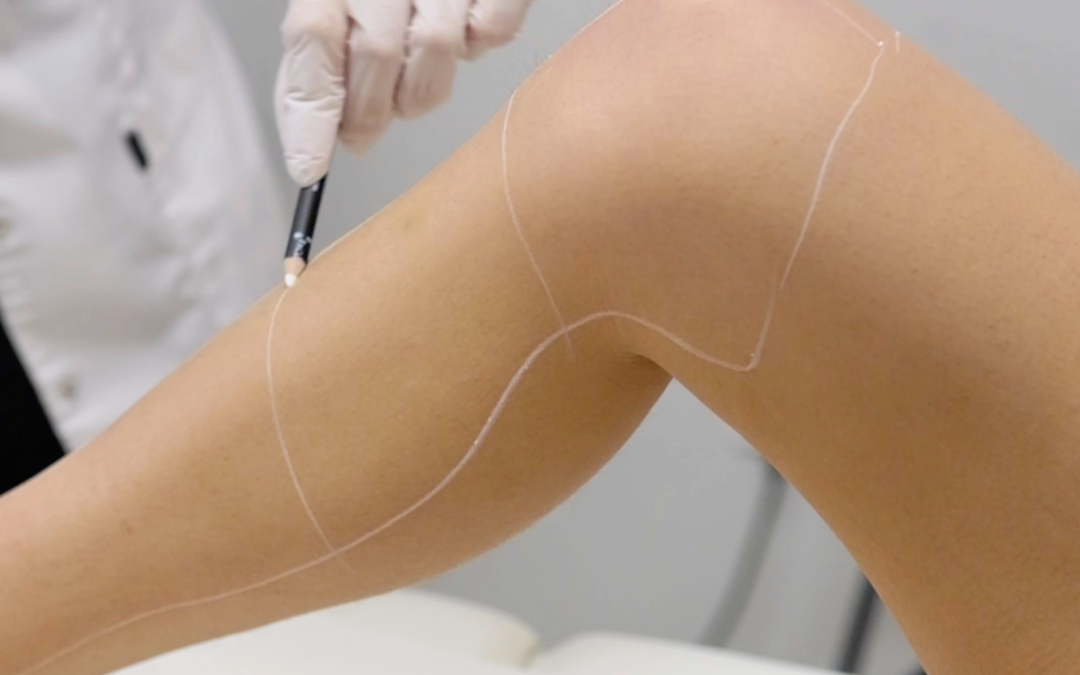 Les bénéfices de l’épilation laser