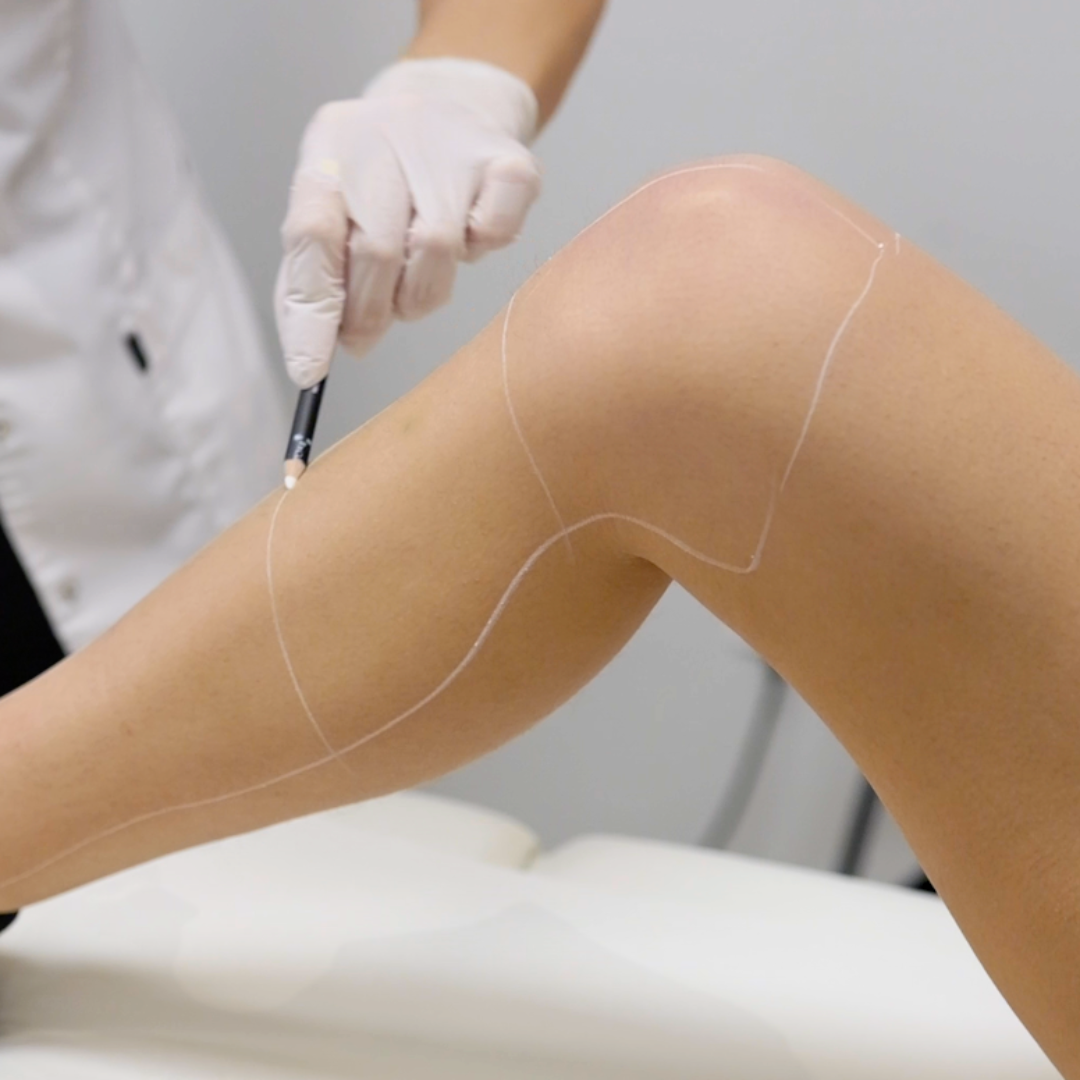 épilation définitive lyon