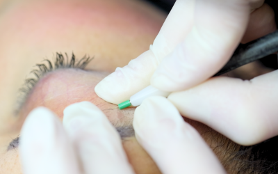 Qu’est ce que l’épilation par électrolyse