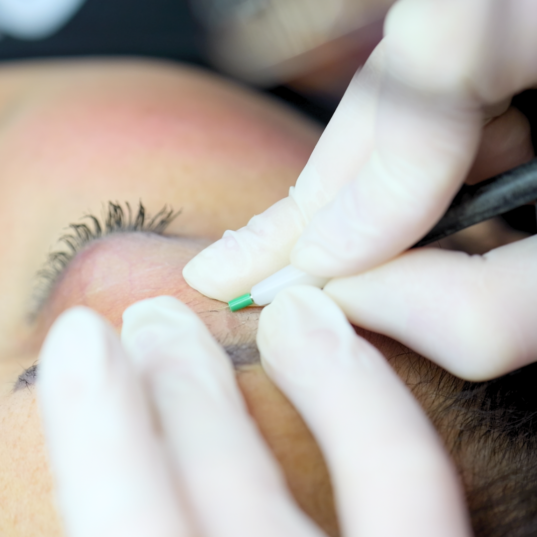 épilation électrolyse