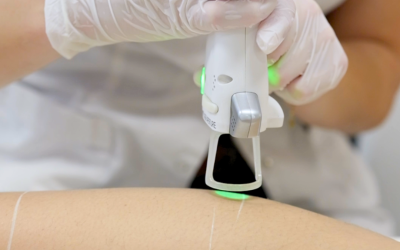 Est-ce que l’épilation laser marche vraiment ?