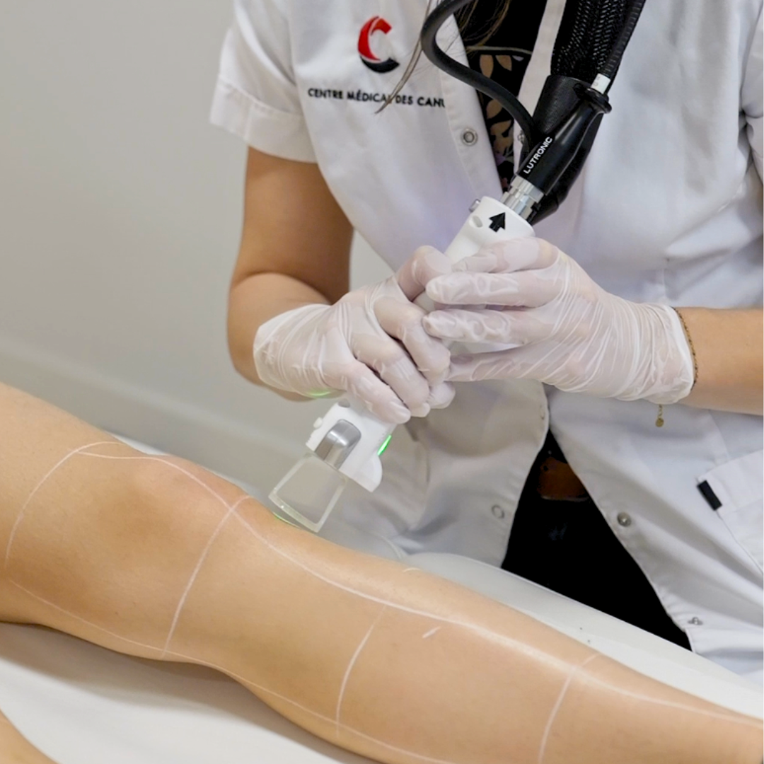 épilation laser lyon