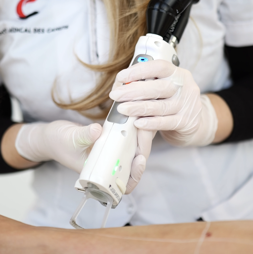 épilation laser alyon