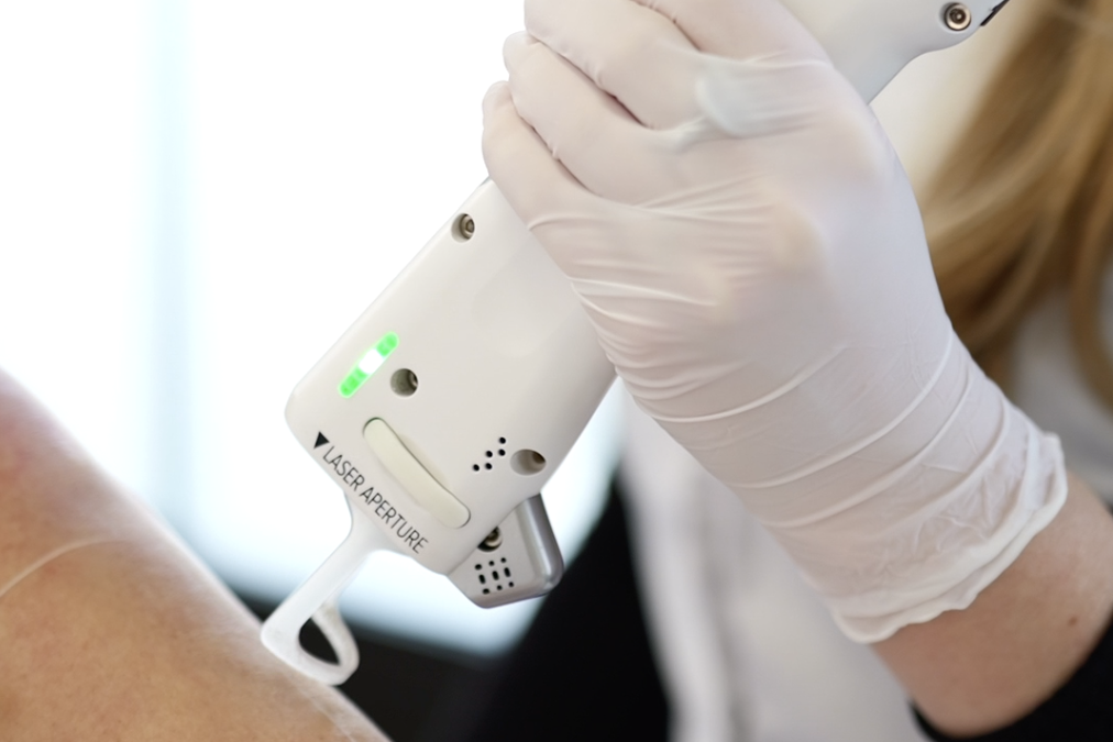 Quel budget pour une épilation laser ?