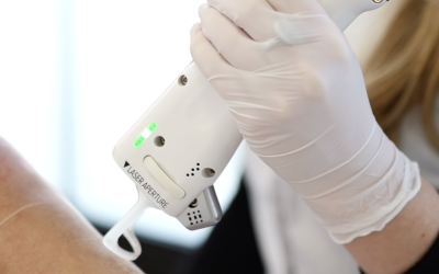 Quel budget pour une épilation laser ?