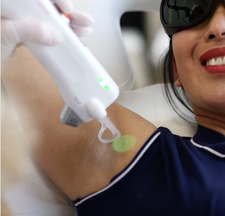 épilation au laser lyon