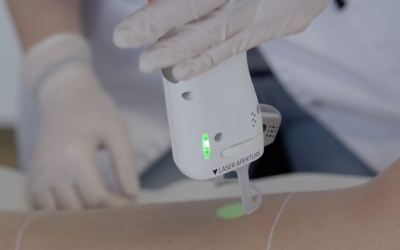 Qui ne peut pas faire une épilation laser ?