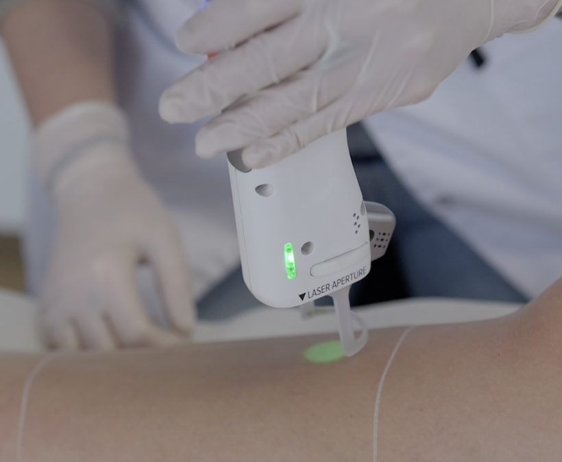 Qui ne peut pas faire une épilation laser ?