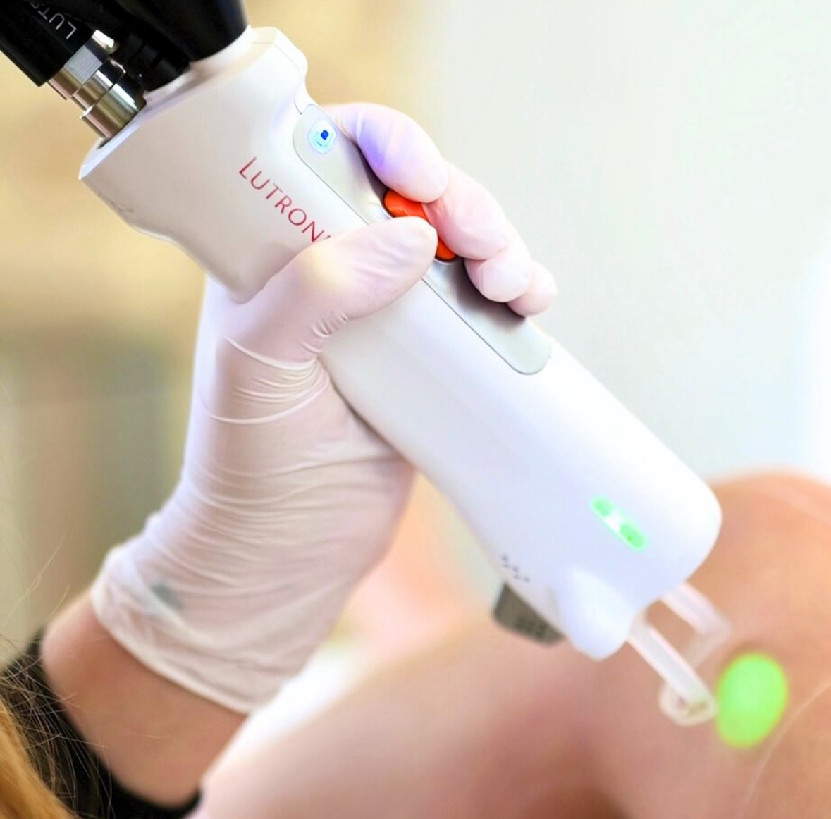 épilation laser à lyon