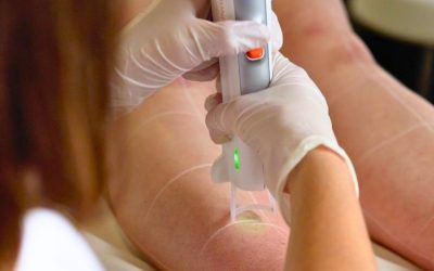 L’IA et l’épilation laser