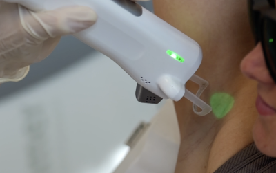 Épilation laser et poils clairs