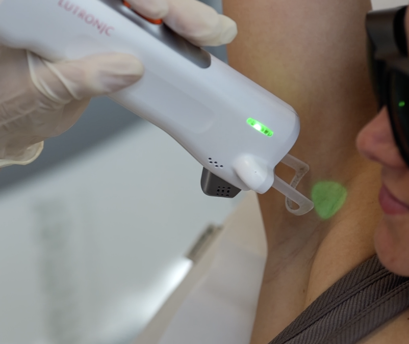 Épilation laser et poils clairs