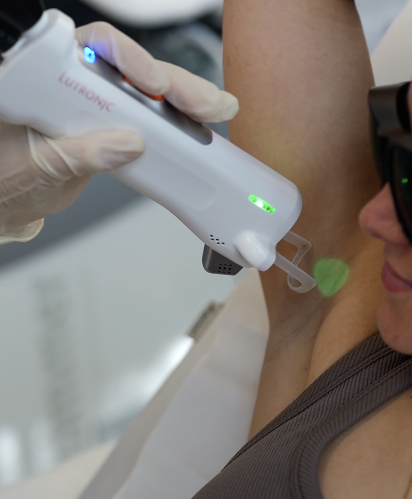 épilation laser et poils clairs