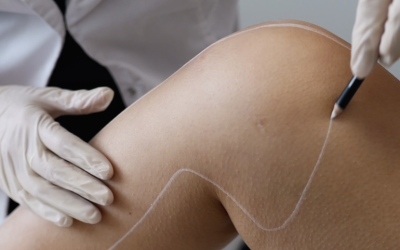 L’histoire de l’épilation laser