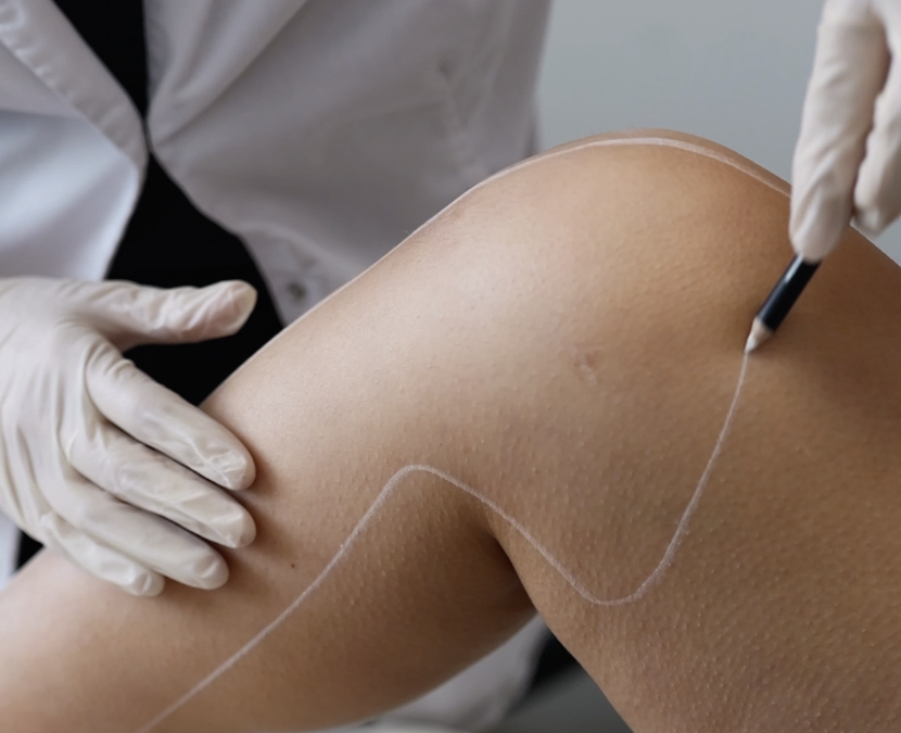 L’histoire de l’épilation laser