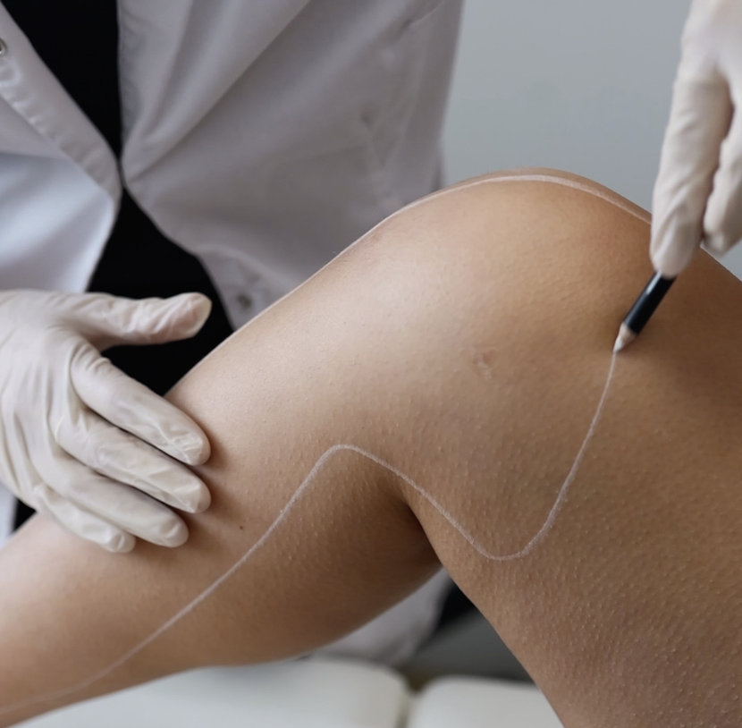 L’histoire de l’épilation laser