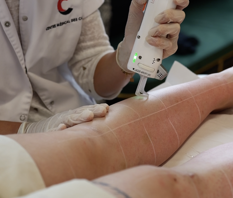 Comment fonctionne le laser sur le follicule pileux ?