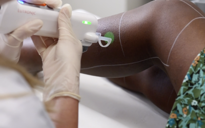 Comment fonctionne le laser sur le follicule pileux ?