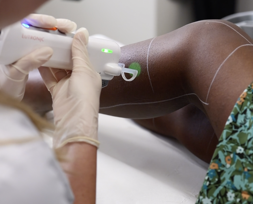 Comment fonctionne le laser sur le follicule pileux ?