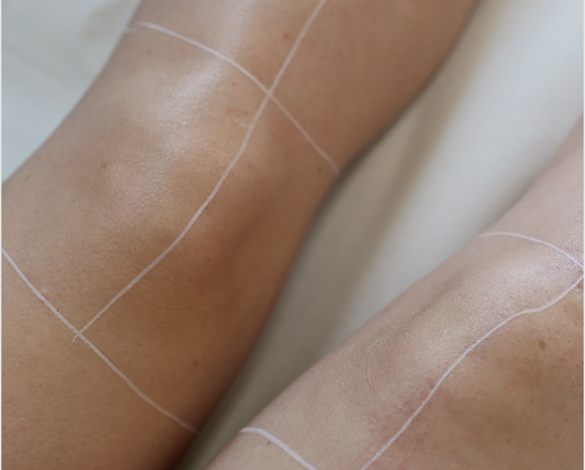 Coup de soleil avant l’épilation laser