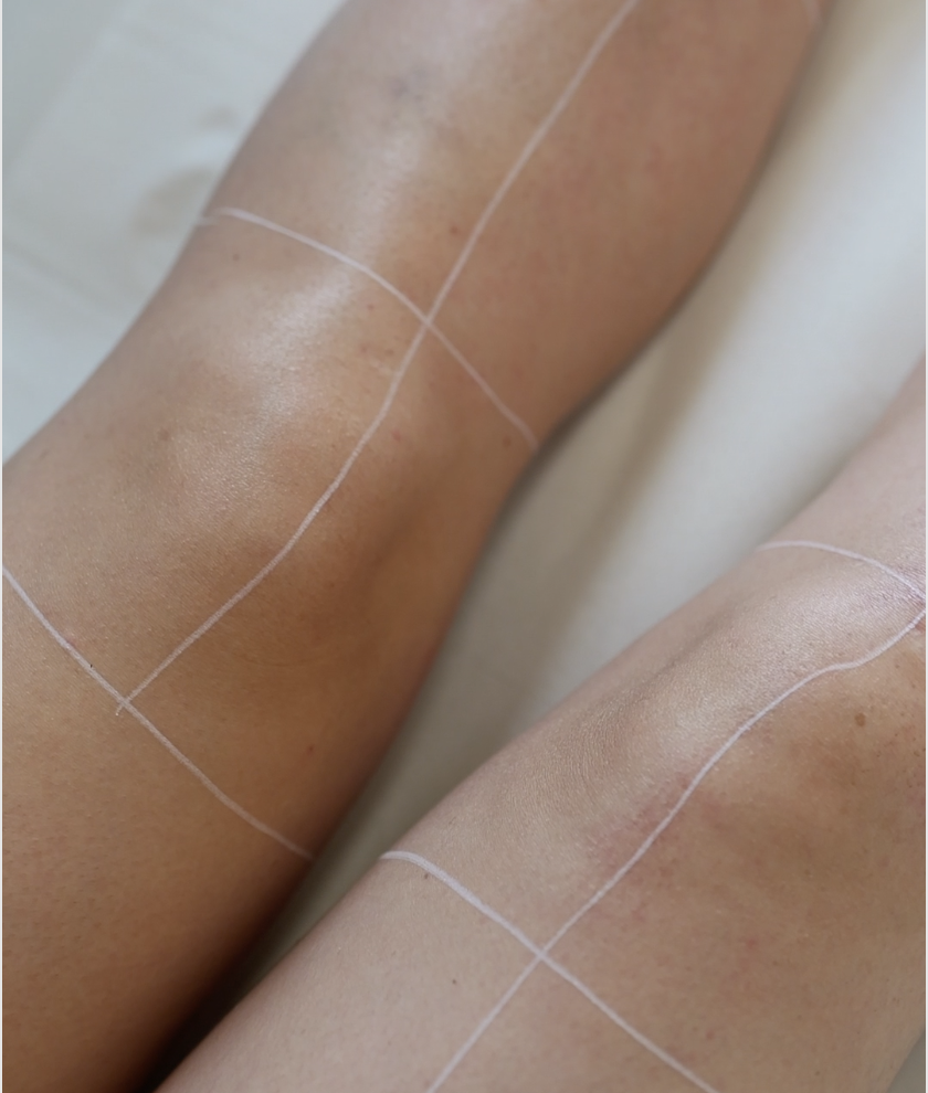 Coup de soleil avant l'épilation laser 