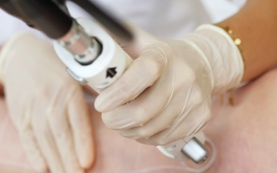 Planning épilation laser