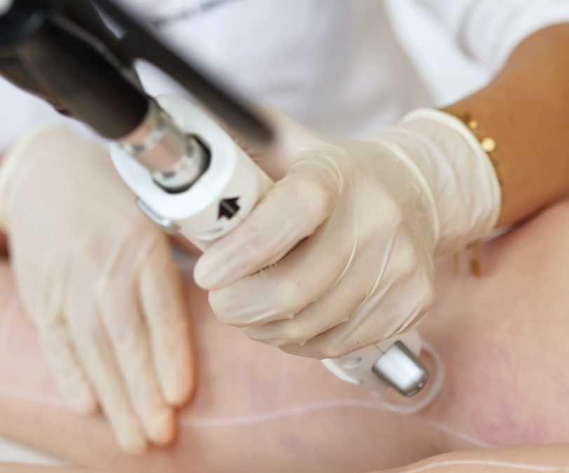 Planning épilation laser