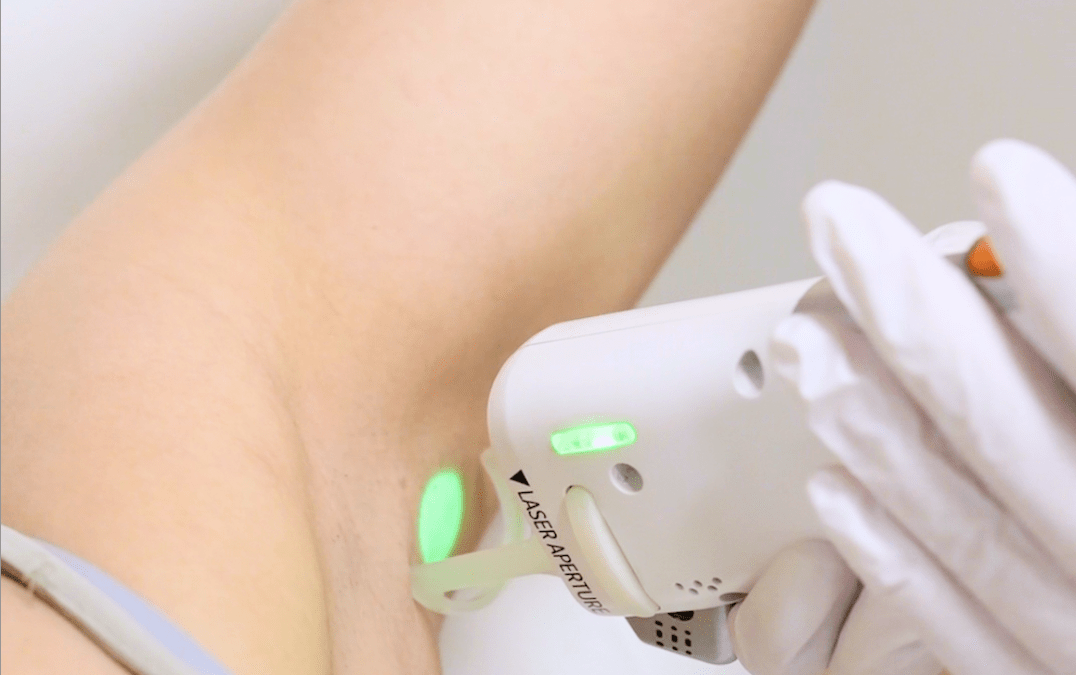 Épilation laser : quels résultats peut-on réellement attendre ?