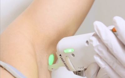 Épilation laser : quels résultats peut-on réellement attendre ?